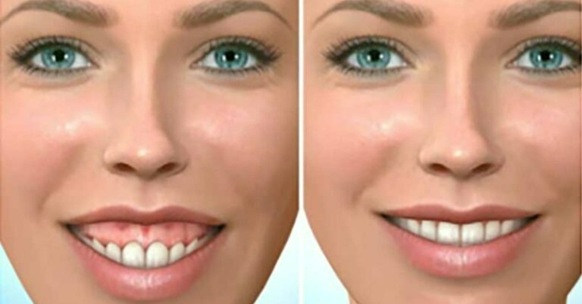 Popular Gummy Smile Correction Options